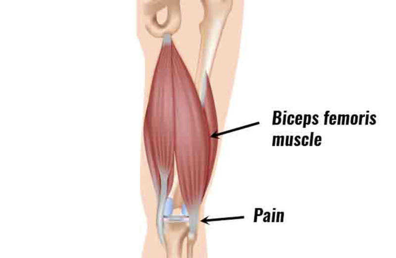biceps-femoris-tendinopathy-distal-