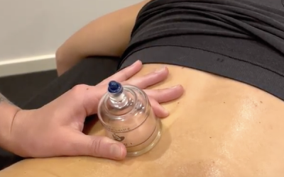 Lower back pain? Answer: Cupping!
