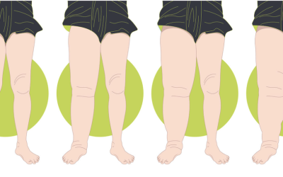 What is Lipoedema?