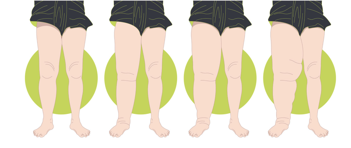 Specialized Liposuction Is Shown to Prevent Lipedema Progression