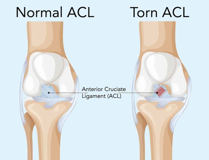 pre surgery ACL tear