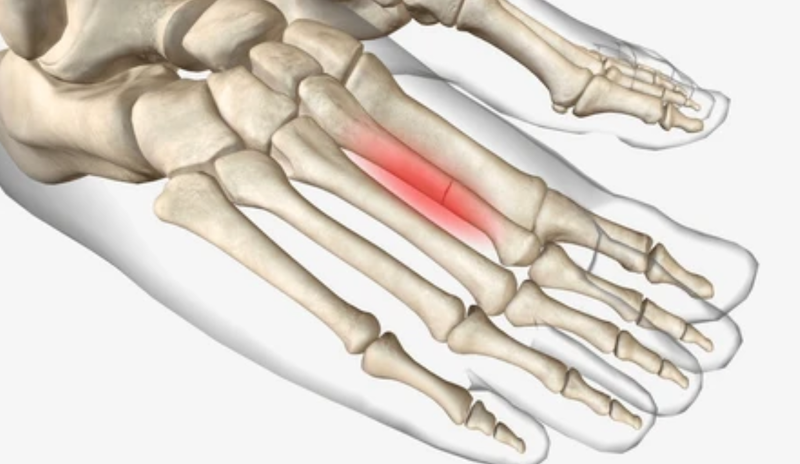 Stress Fractures from running injury